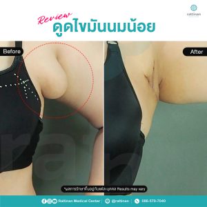 ดูดไขมันนมน้อย จำกัดไขมันใต้รักแร้