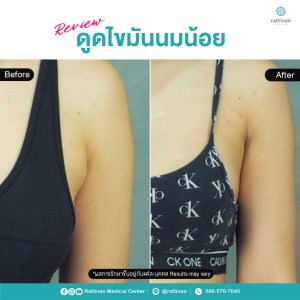 ดูดไขมันนมน้อย จำกัดไขมันใต้รักแร้