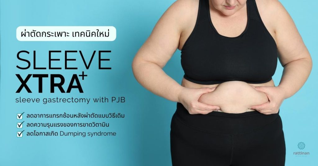 วิธีผ่าตัดกระเพาะ ลดน้ำหนัก รักษาโรคอ้วน Sleeve xtra เทคนิคใหม่