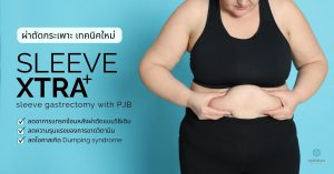 วิธีผ่าตัดกระเพาะ ลดน้ำหนัก รักษาโรคอ้วน Sleeve xtra เทคนิคใหม่