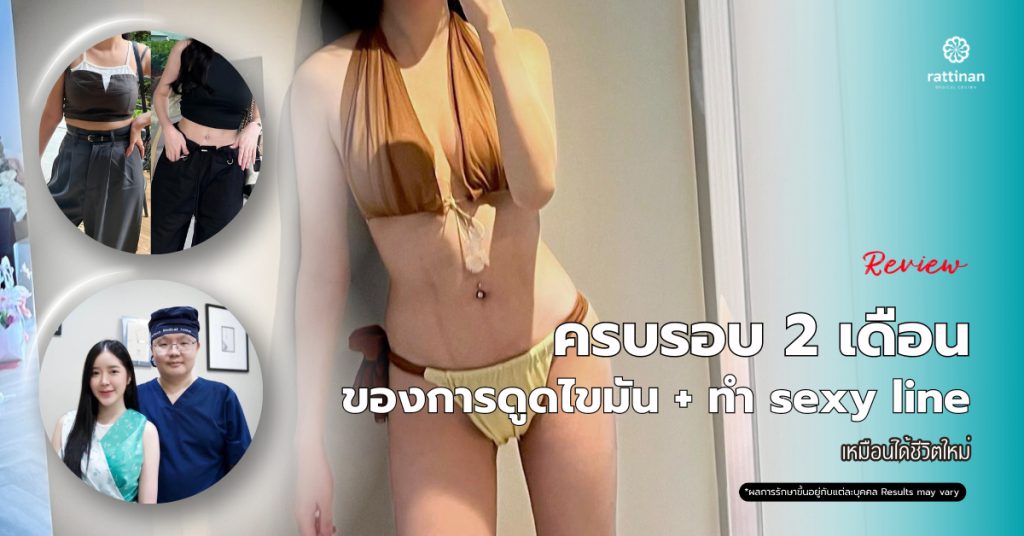 รีวิว ครบรอบ 2 เดือน ของการดูดไขมัน + ทำ sexy line