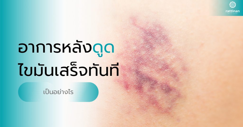 อาการหลังดูดไขมันเสร็จทันที