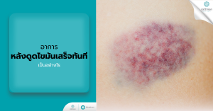 อาการหลังดูดไขมันเสร็จทันที