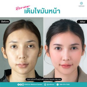 รีวิว เติมไขมันหน้า เทคนิคเกาหลี