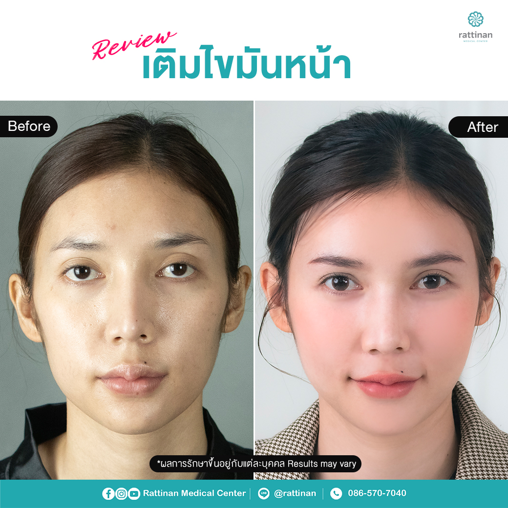 รีวิว เติมไขมันหน้า เทคนิคเกาหลี