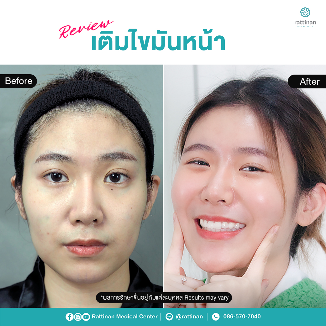 รีวิว เติมไขมันหน้า เทคนิคเกาหลี