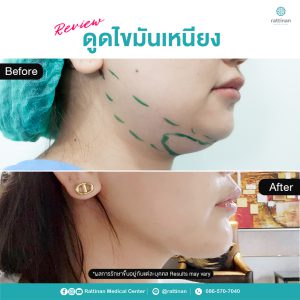 ดูดไขมันเหนียง กรอบหน้าคมชัด