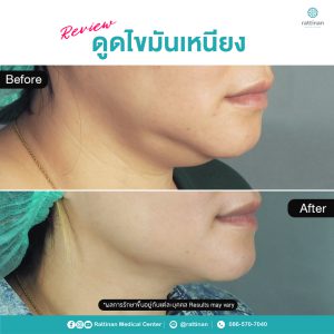 ดูดไขมันเหนียง ไขมันใต้คาง