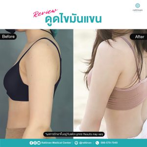 รีวิว ดูดไขมันแขน ให้แขนเรียวเล็ก