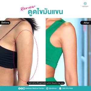 รีวิว ดูดไขมันต้นแขน กระชับแขน