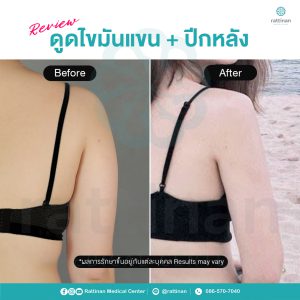รีวิว ดูดไขมันแขน และปีกหลัง