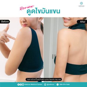 รีวิว ดูดไขมันต้นแขน แขนใหญ่