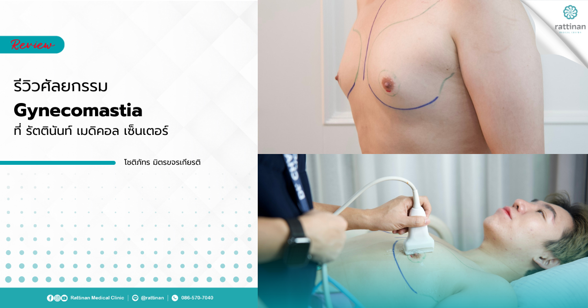 รีวิวศัลยกรรม Gynecomastia