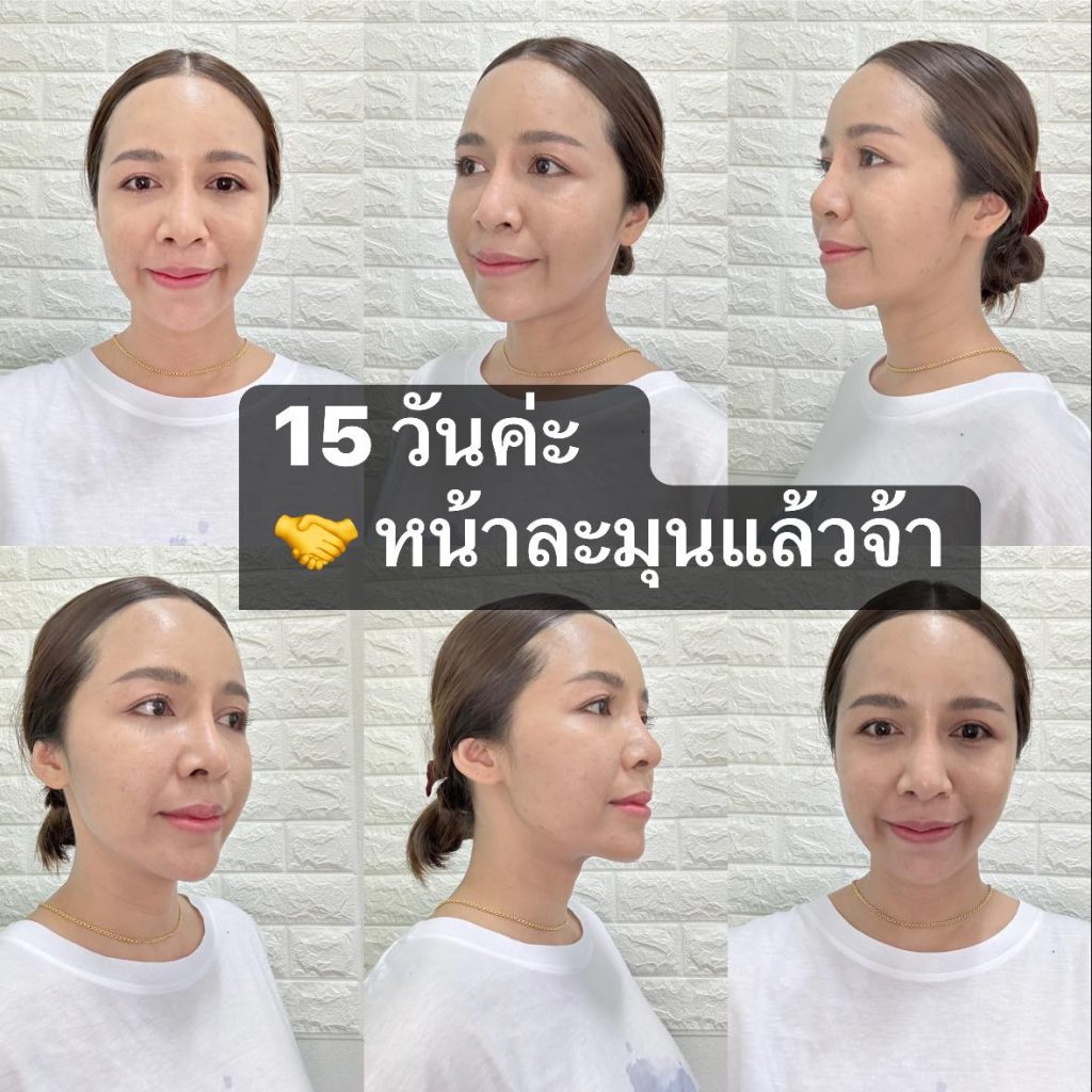 รีวิว หลังฉีดไขมันหน้า 15 วัน