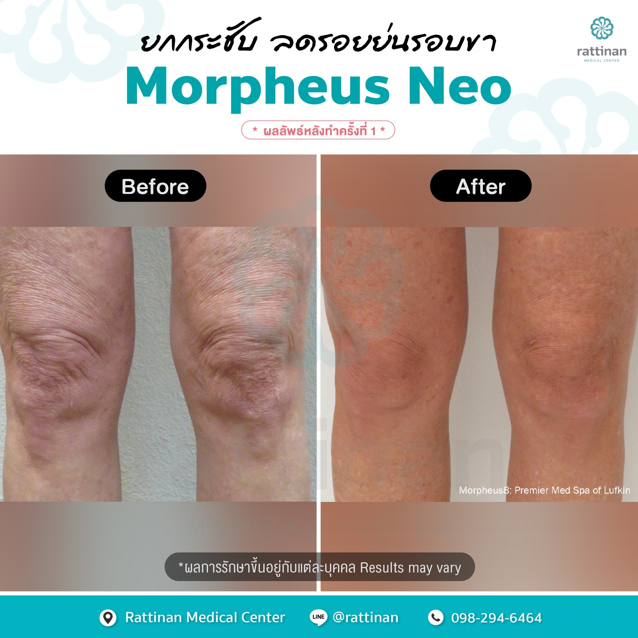 Morpheus NEO ภาพรีวิวเข่า