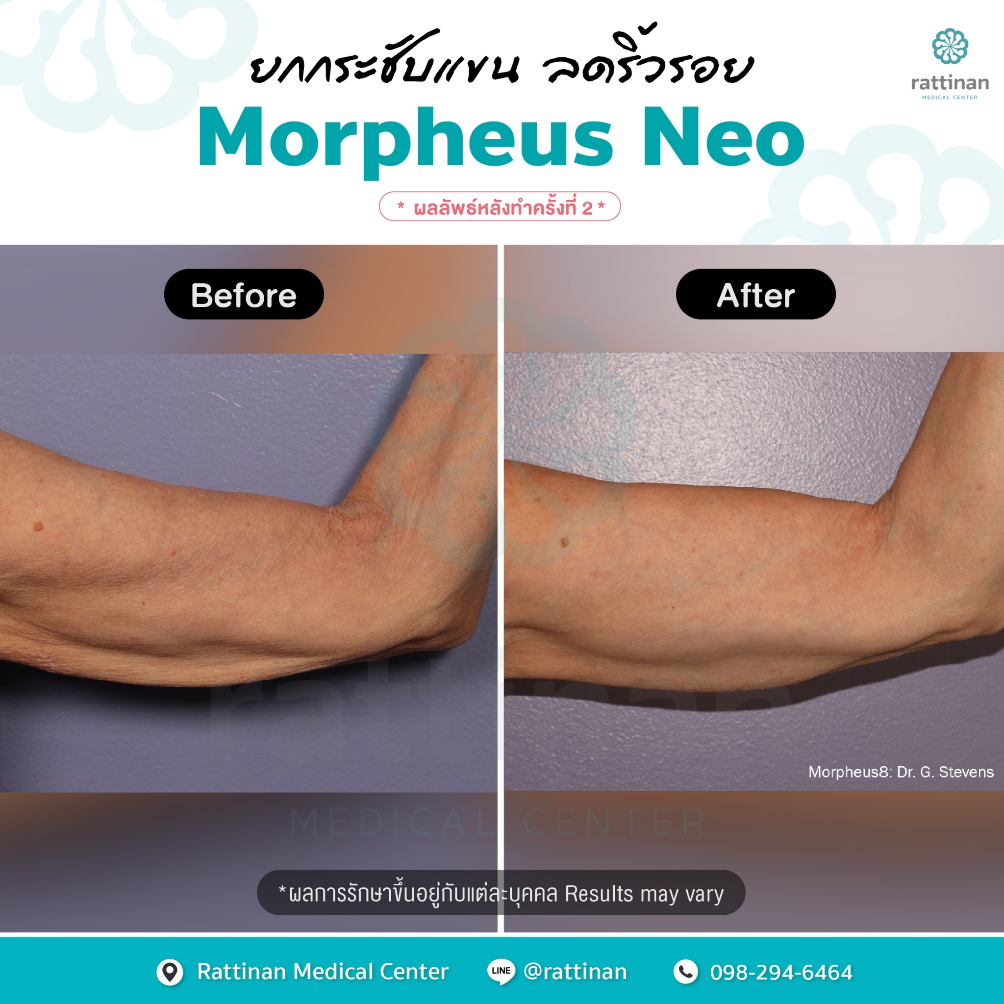 Morpheus NEO ภาพรีวิวแขน