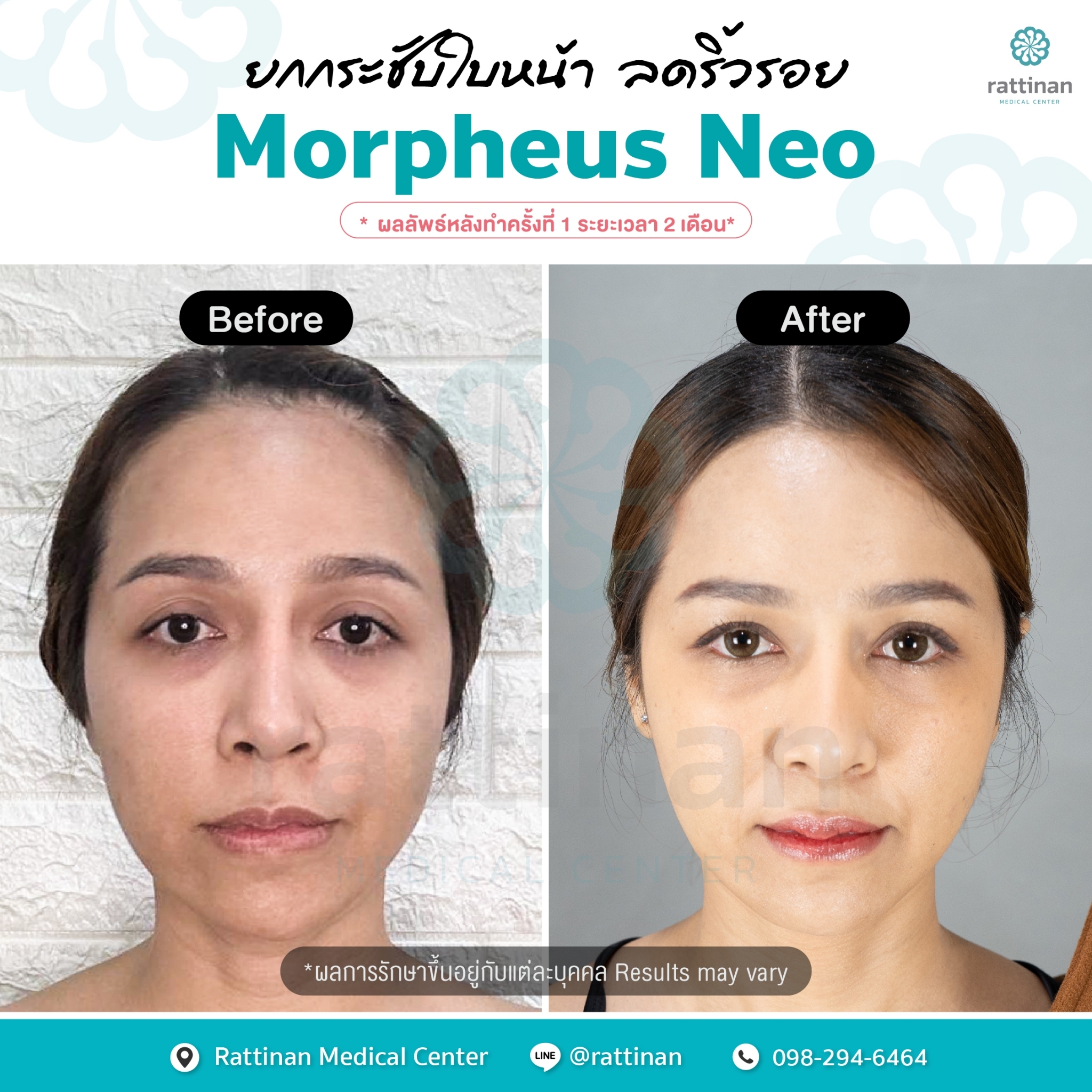 ภาพรีวิว Morpheus NEO 5