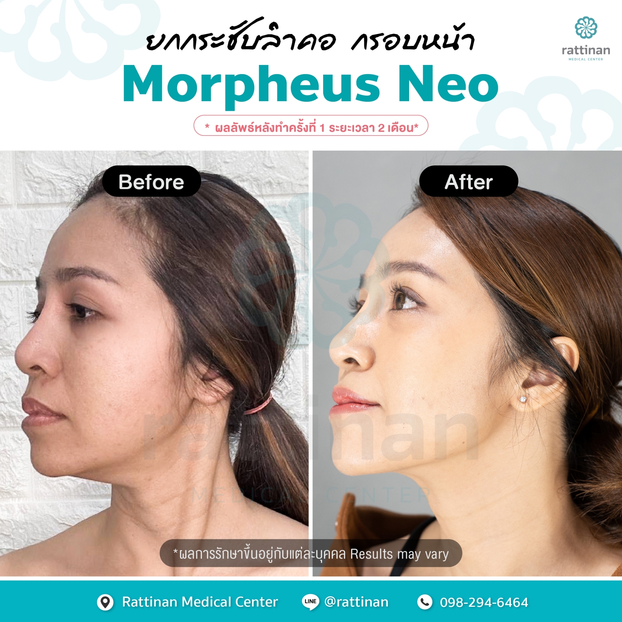 Morpheus NEO ภาพรีวิวคอ