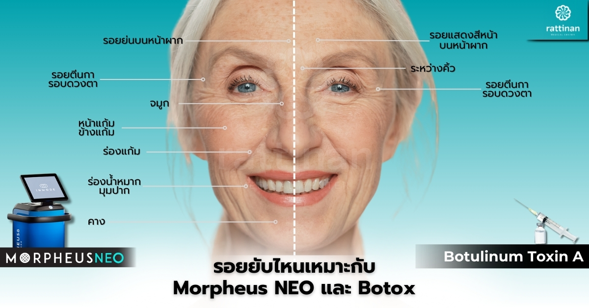 Morpheus NEO vs Botox