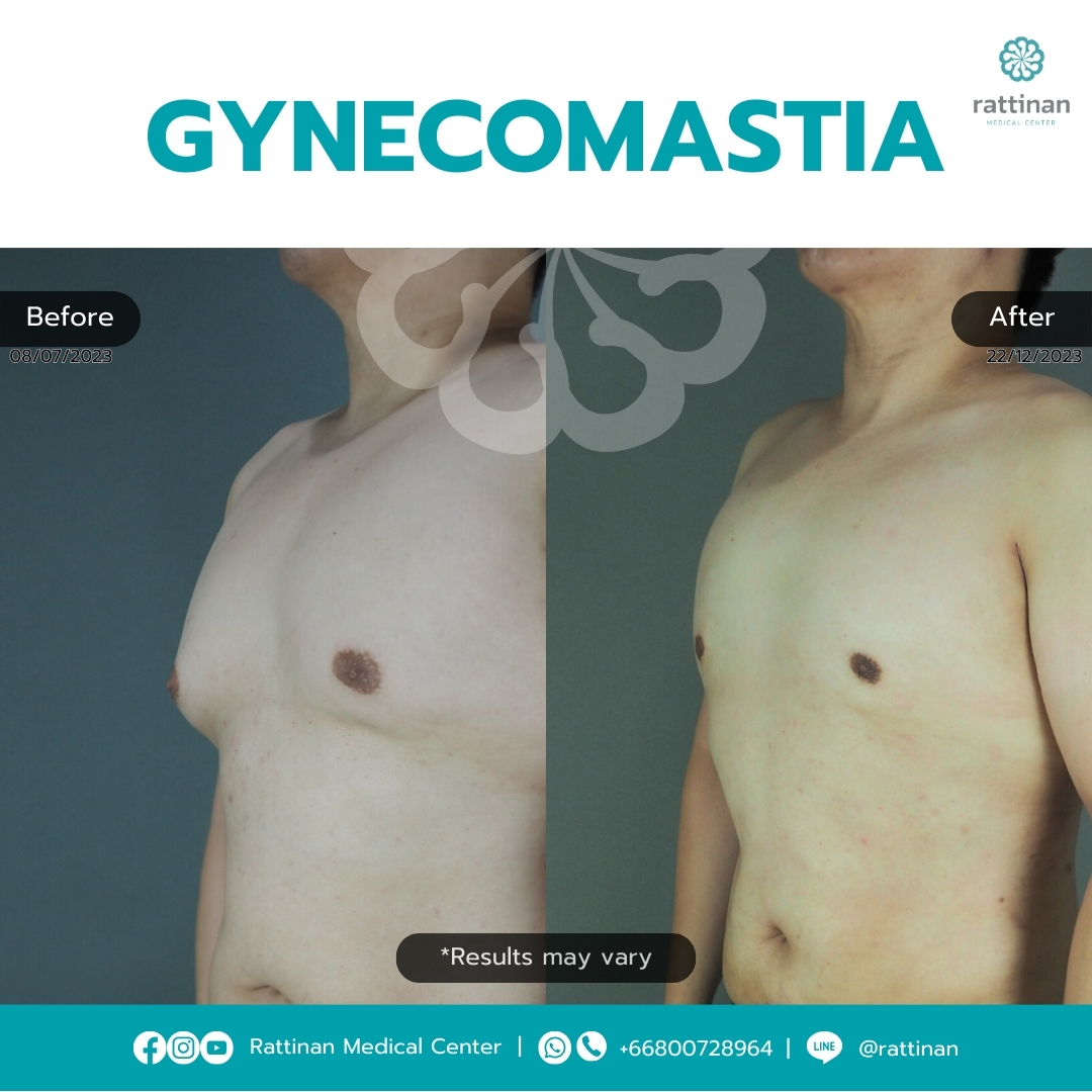 Gynecomastia Before & After