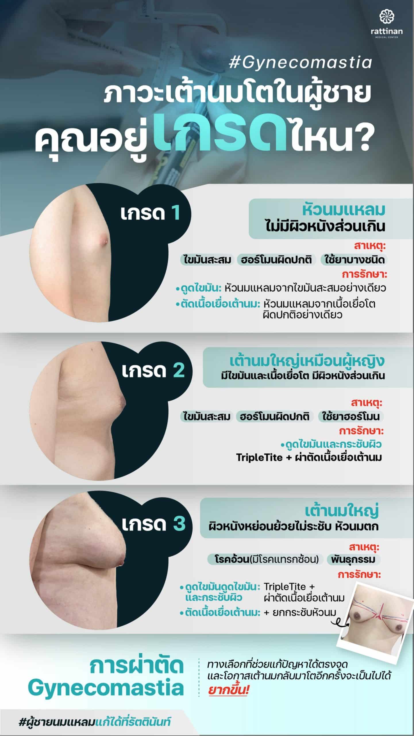 วิธีลดหน้าอกผู้ชายจากไขมันส่วนเกิน รักษาระดับไหนได้บ้าง