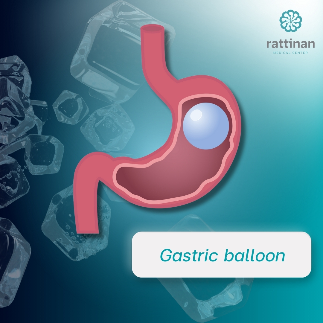 Gastric balloon เทคนิค