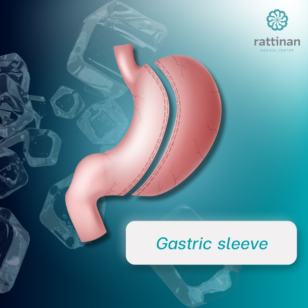 Gastric sleeve เทคนิค