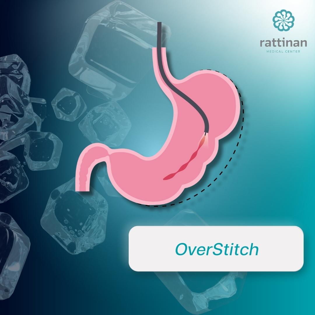 OverStitch เทคนิค