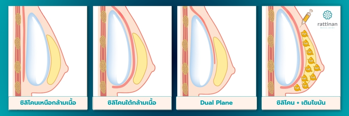 ประเภทของการเสริมหน้าอก