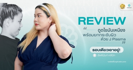รีวิว ดูดไขมันเหนียง