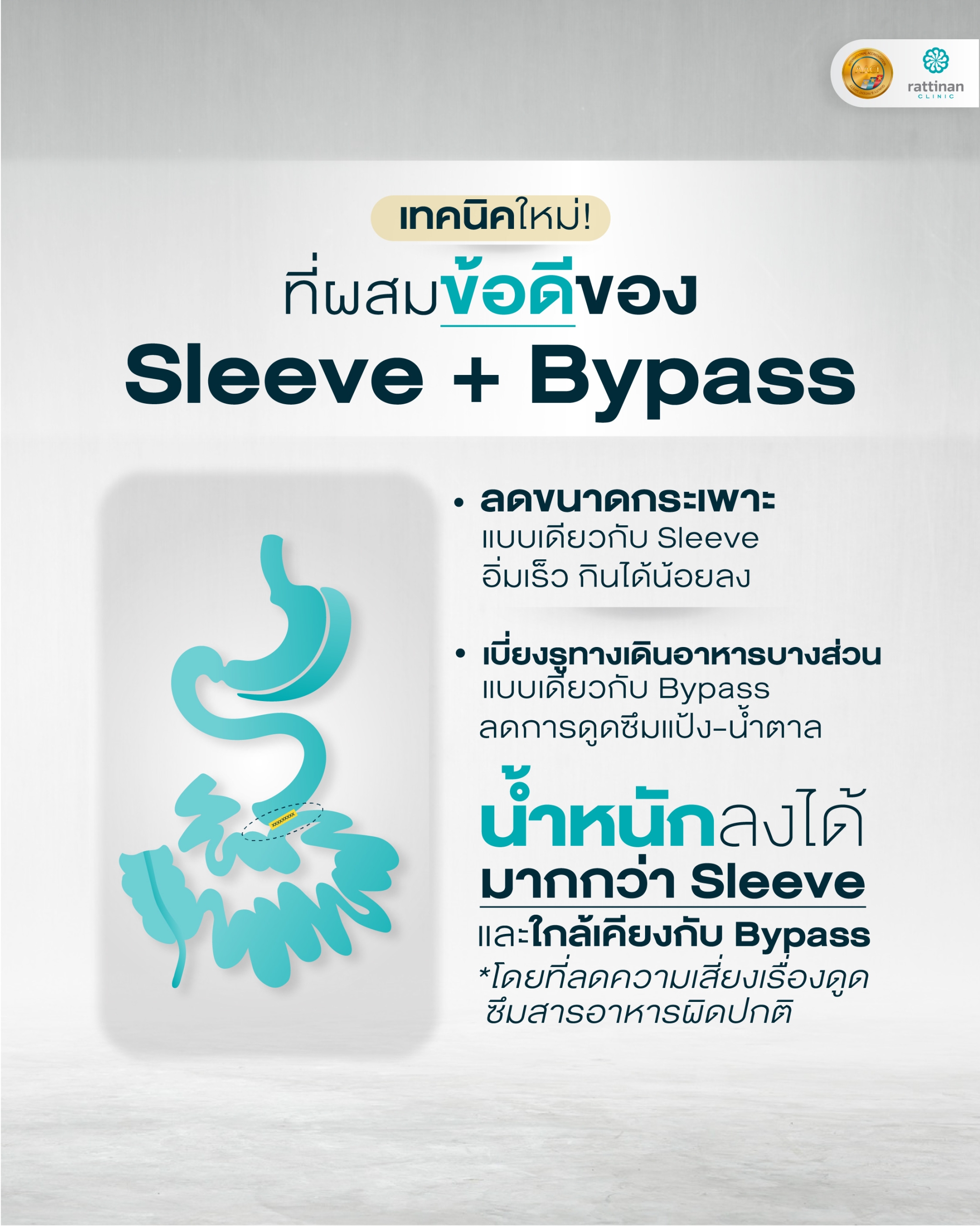 ผ่าตัดกระเพาะ เทคนิค mini bypass เฉพาะที่ Rattinan