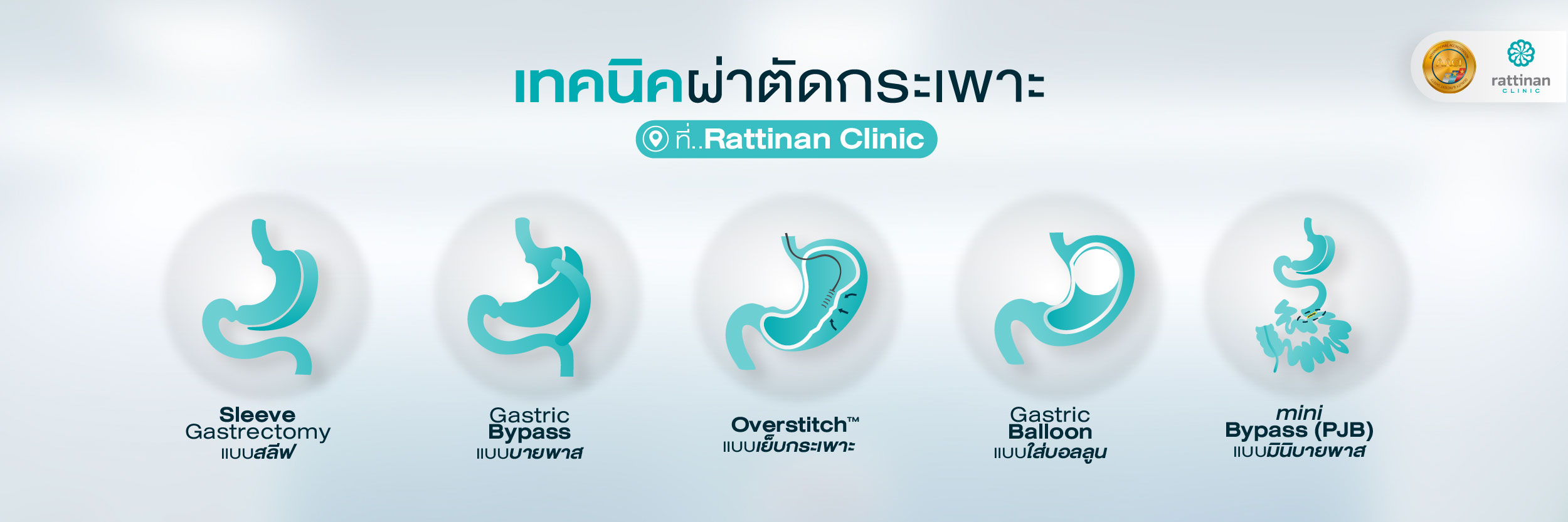 ผ่าตัดกระเพาะ ที่รัตตินันท์ มีกี่ประเภท