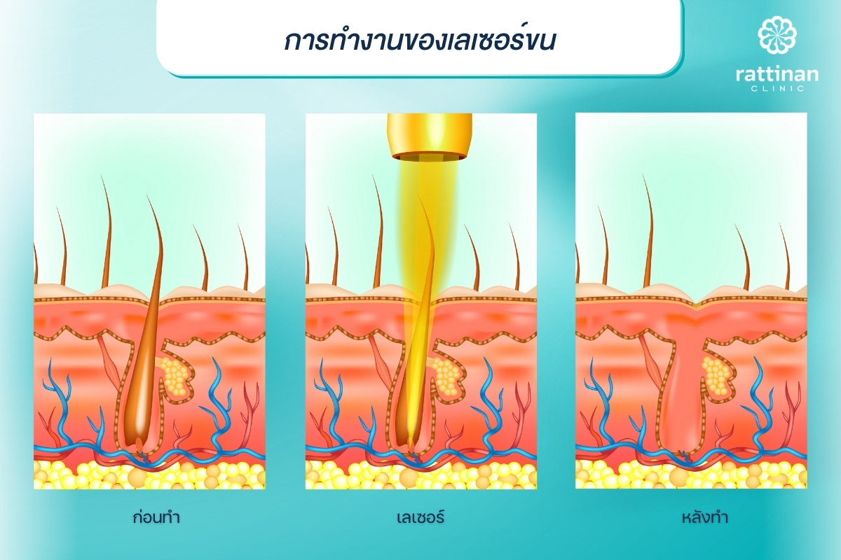 การทำงานของเลเซอร์ขน