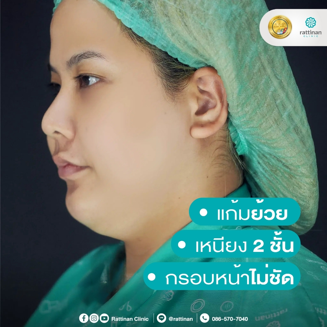 เหนียง 2 ชั้น