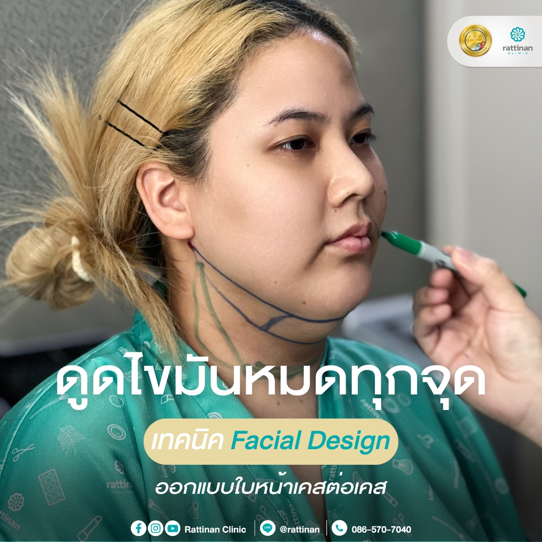 ดูดไขมันเหนียงหมดทุกจุด เทคนิค Facial Design รัตตินันท์