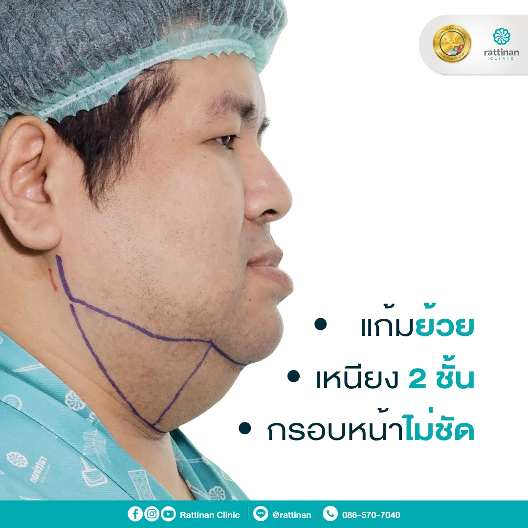 แก้มย้วย ดูดไขมันเหนียง