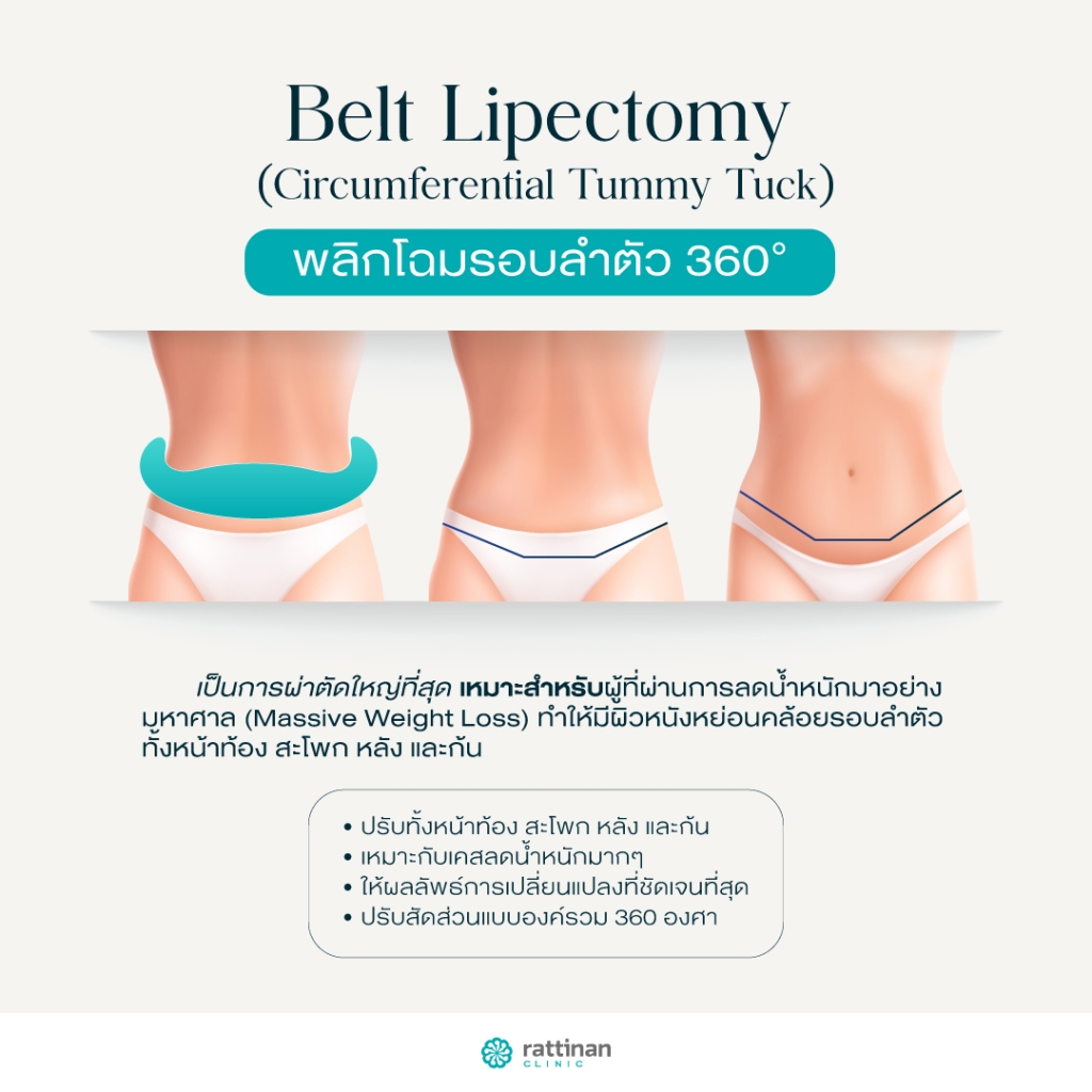 Belt Lipectomy