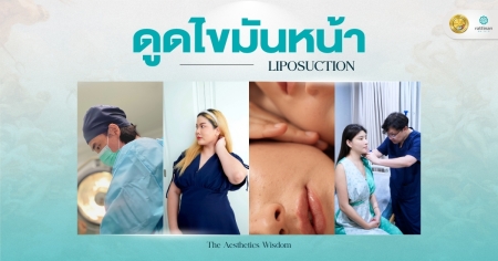 ดูดไขมันหน้า