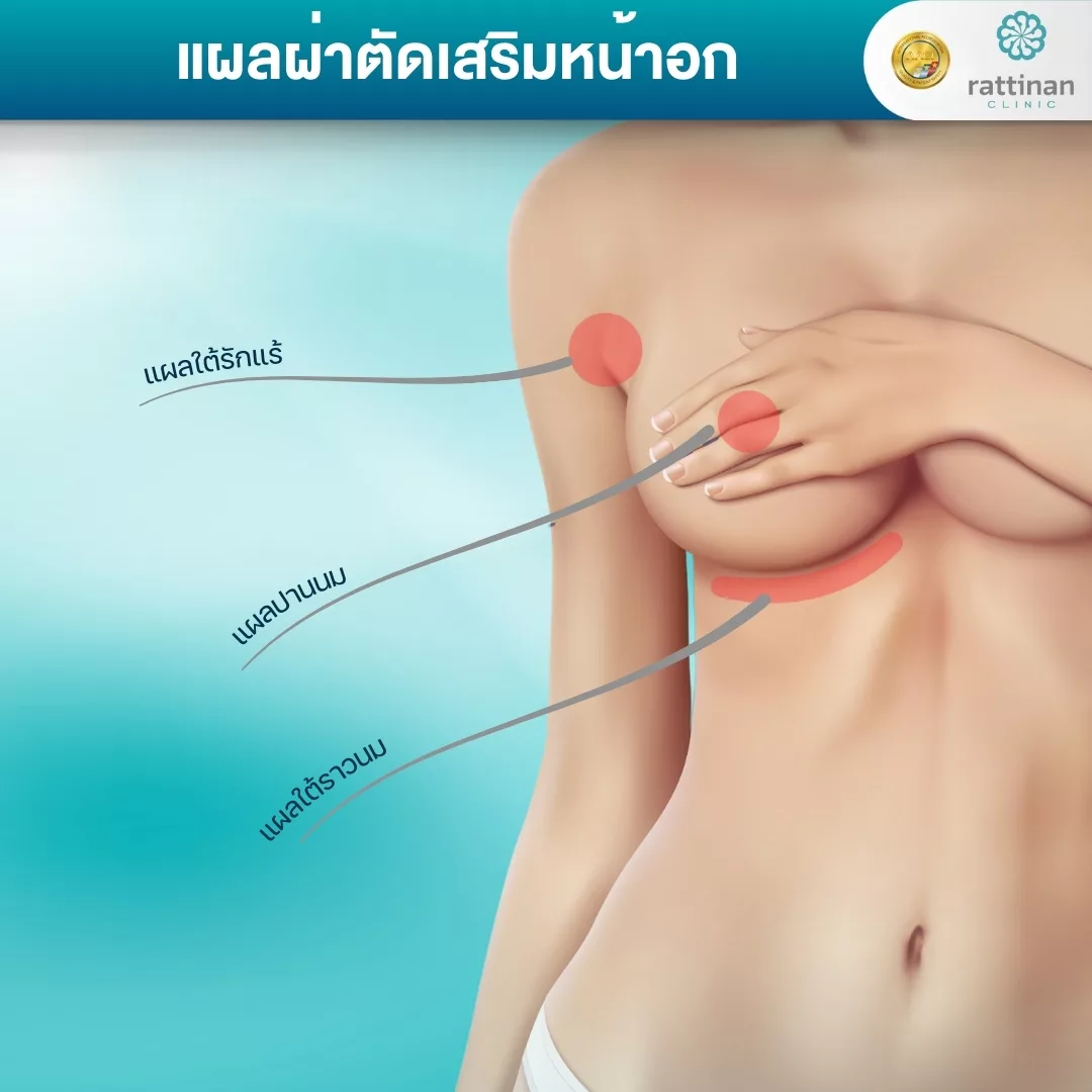 แผลผ่าตัดเสริมหน้าอก