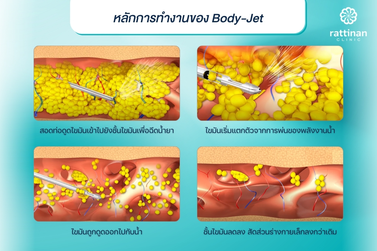 หลักการทำงานของเครื่องดูดไขมัน Body-Jet