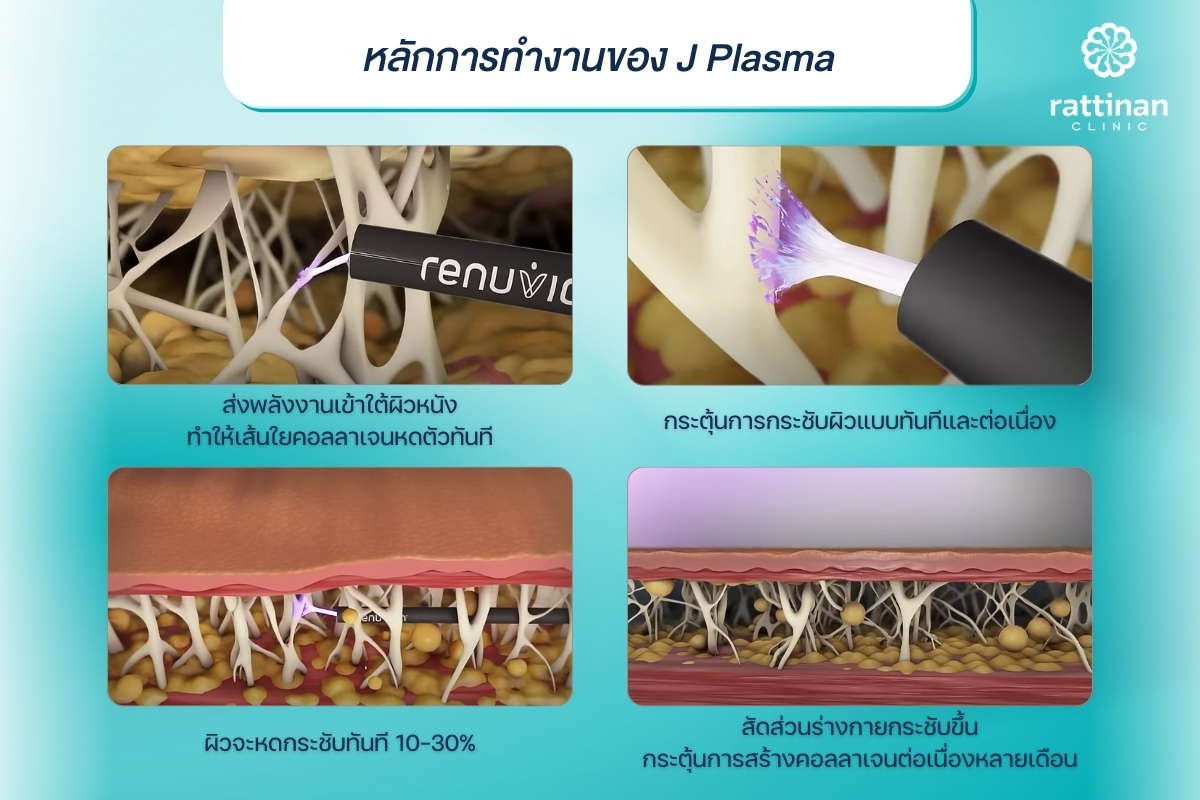 หลักการทำงานของเครื่อง J Plasma