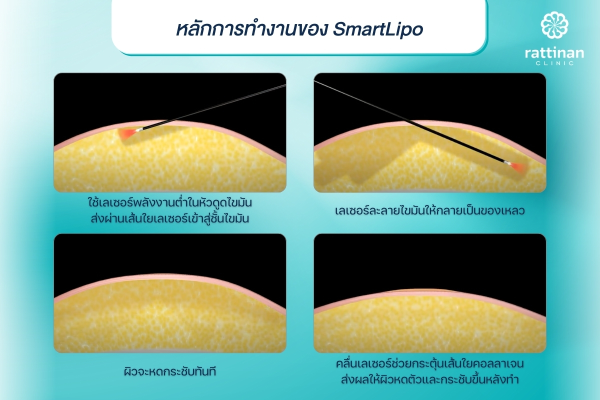 หลักการทำงานของเครื่องดูดไขมัน SmartLipo