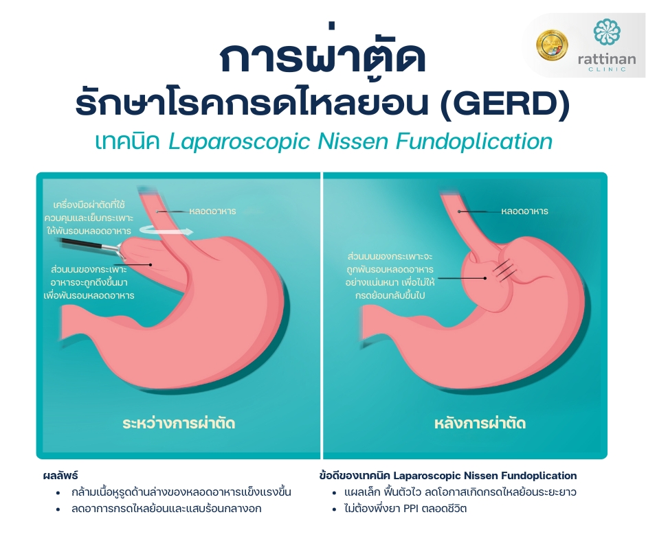 รักษาโรคกรดไหลย้อน (GERD) เทคนิค Laparoscopic Nissen Fundoplication