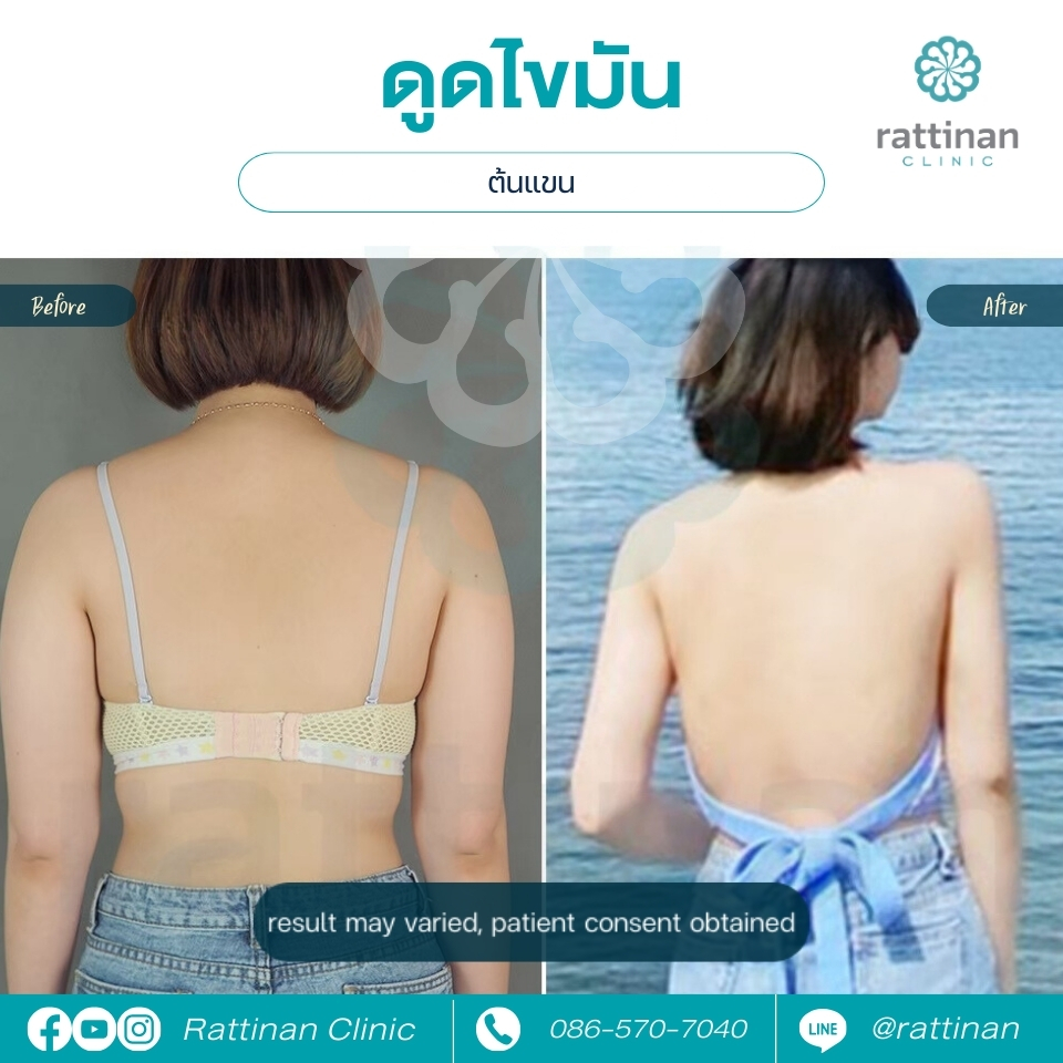 รีวิว ก่อน-หลัง ดูดไขมันต้นแขน