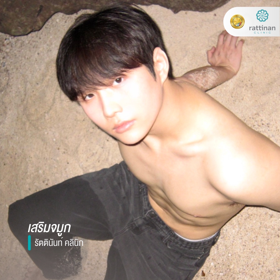 เสริมจมูก รัตตินันท์ รีวิว 1