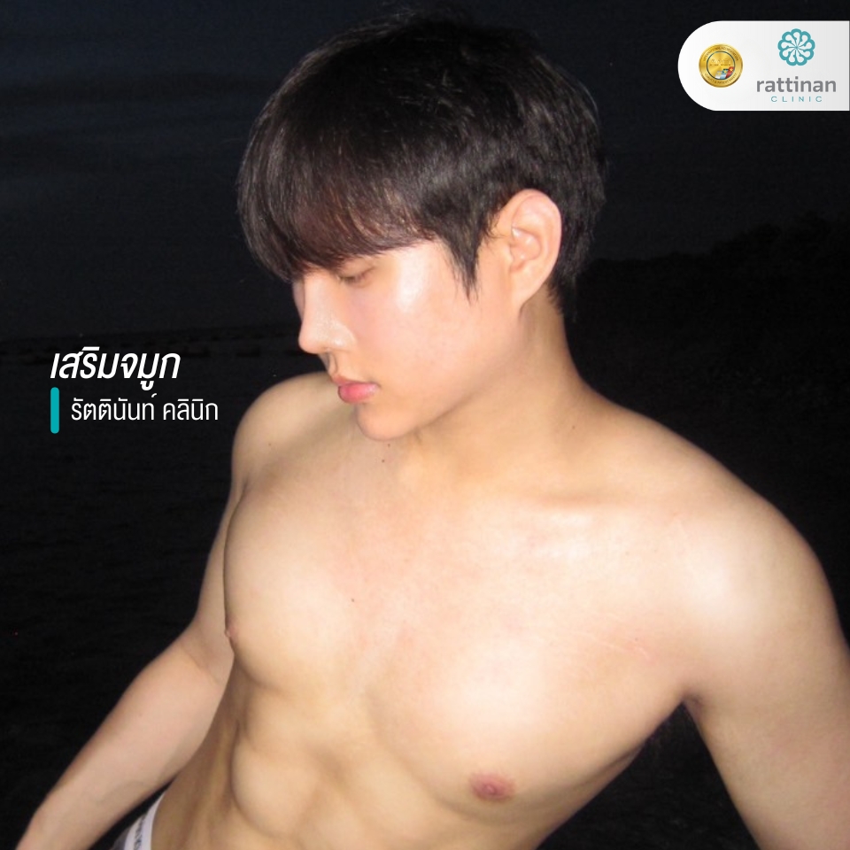 เสริมจมูก รัตตินันท์ รีวิว 3