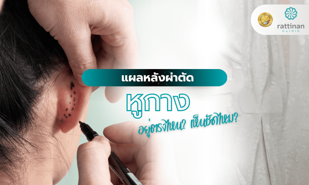 แผลหลังผ่าตัดหูกางอยู่ตรงไหน? เห็นชัดไหม?