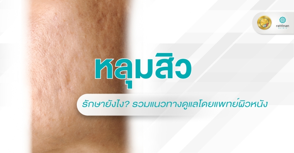 หลุมสิว