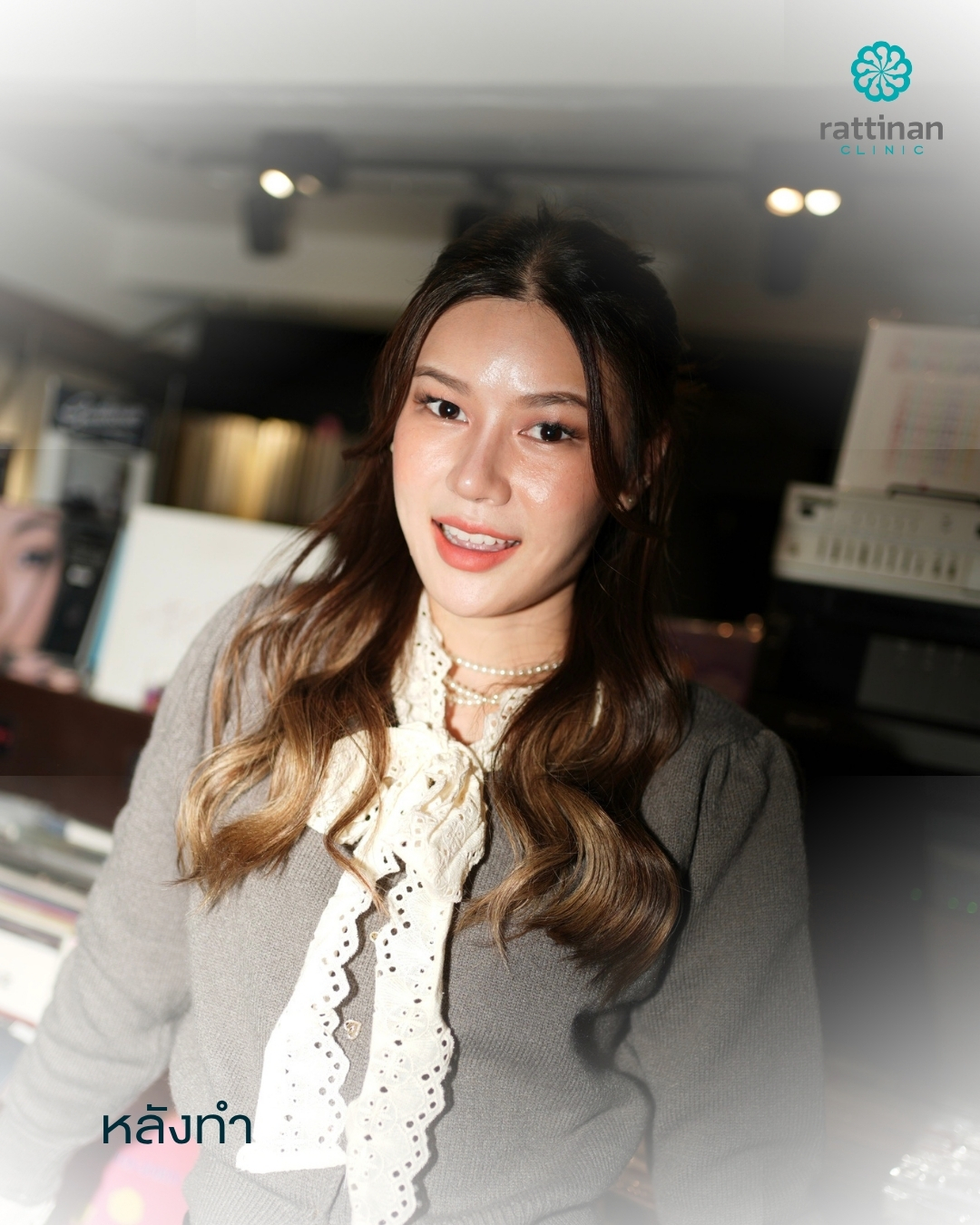 Testimonials Facial fat grafting - Spom after