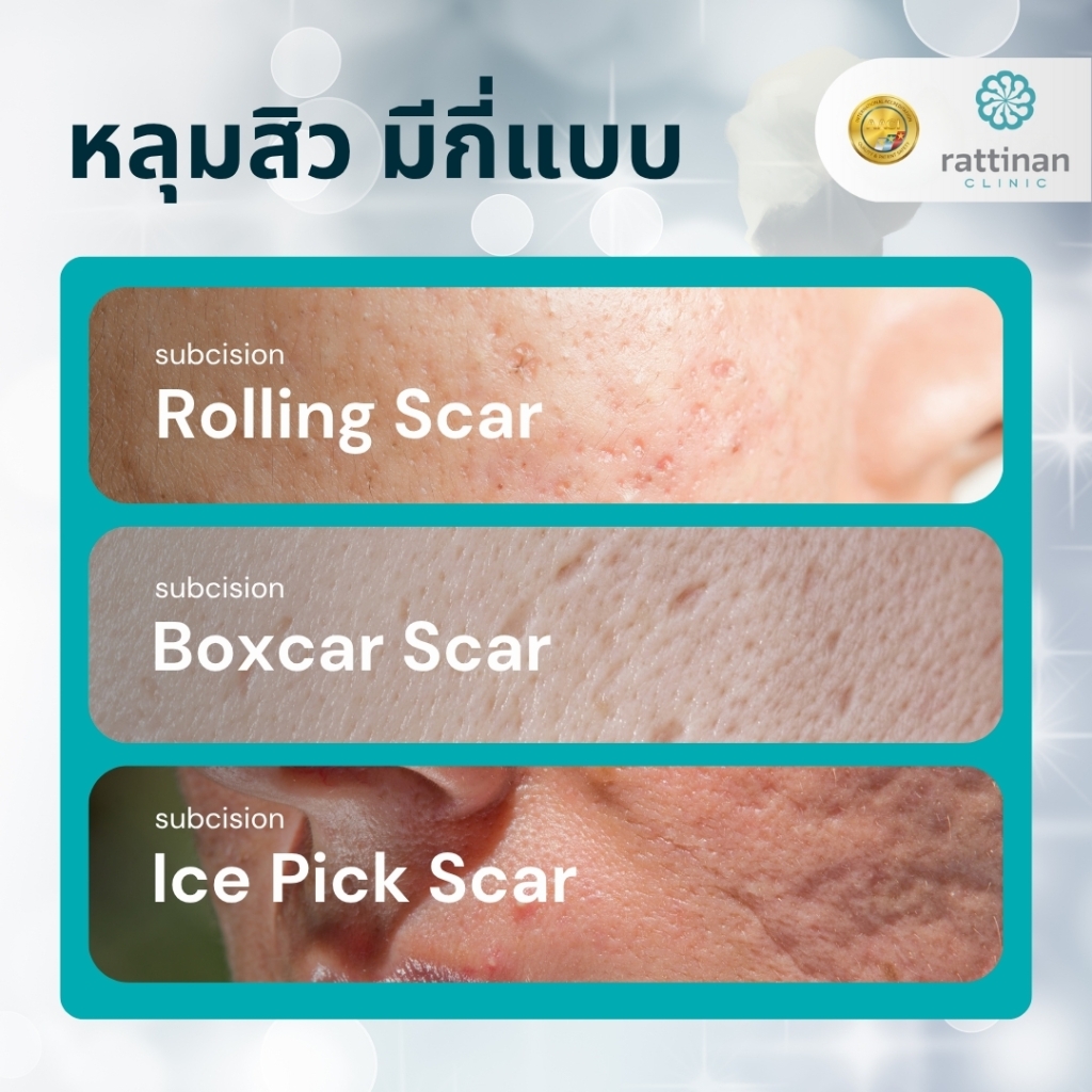หลุมสิวมีกี่แบบ